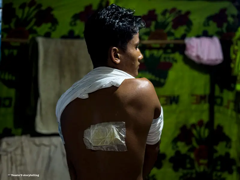 رجل روهينجي: قد تتلاشى ندبتي، لكن الصدمة والكوابيس التي عانيتها ستظل تطاردني إلى الأبد