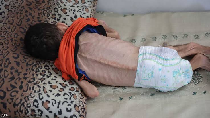 عمداً .. العالم يقوم بتجويع غزة!! 45 عمداً .. العالم يقوم بتجويع غزة!!